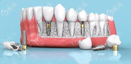 瑞典諾貝爾種植體類(lèi)型多，適應(yīng)癥廣泛