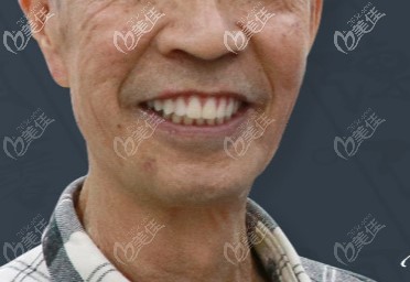 這就系做了滿口種植牙后的郭老 這就系做了滿口種植牙后的郭老