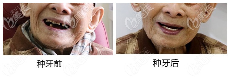 百歲老人種牙前后<span style=