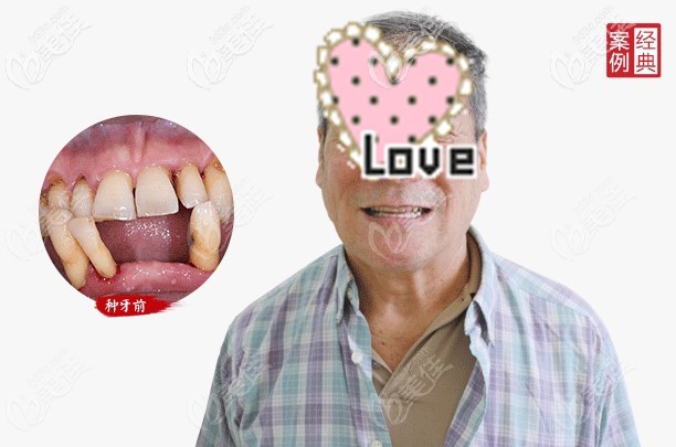 重度牙周炎的黎叔叔體驗(yàn)了即刻負(fù)重種植牙 重度牙周炎的黎叔叔體驗(yàn)了即刻負(fù)重種植牙