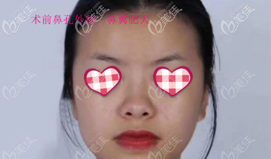 曾熬做鼻子的案例一術(shù)前照片 曾熬做鼻子的案例一術(shù)前照片