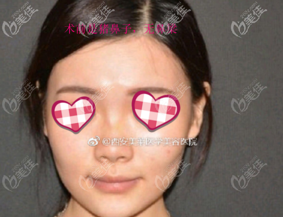 曾熬醫(yī)生做鼻子的案例二術(shù)前照片 曾熬醫(yī)生做鼻子的案例二術(shù)前照片