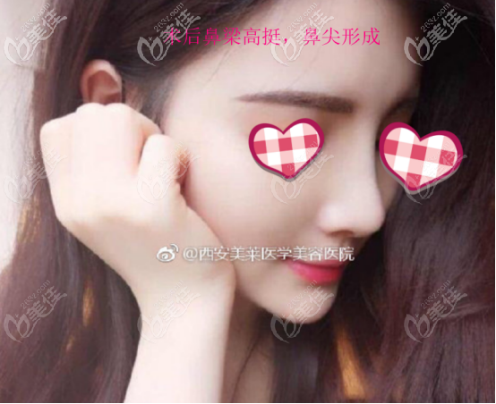 曾熬醫(yī)生做鼻子的案例二術(shù)后照片 曾熬醫(yī)生做鼻子的案例二術(shù)后照片