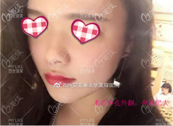 曾熬醫(yī)生做鼻子的案例三術(shù)前照片 曾熬醫(yī)生做鼻子的案例三術(shù)前照片