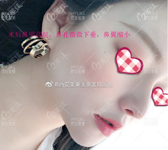 曾熬醫(yī)生做鼻子的案例三術(shù)后照片 曾熬醫(yī)生做鼻子的案例三術(shù)后照片