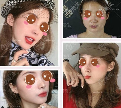 武漢亞韓顴骨下頜角案例 武漢亞韓顴骨下頜角案例