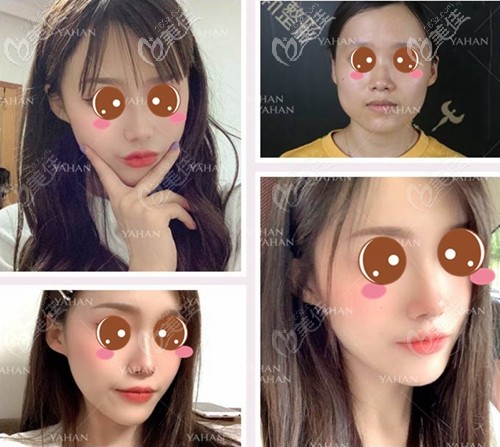 武漢亞韓V-line瓜子臉案例 武漢亞韓V-line瓜子臉案例