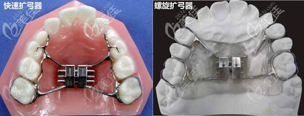擴弓器矯正方式 擴弓器矯正方式