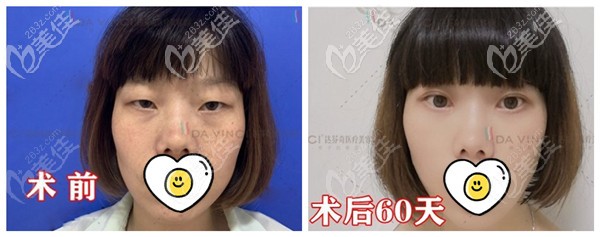 廣元達芬奇全切雙眼皮+上瞼下垂矯正案例 廣元達芬奇全切雙眼皮+上瞼下垂矯正案例