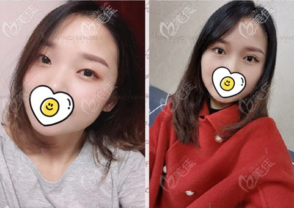 這有在廣元達芬奇割全切雙眼皮案例圖片,你猜她們是多久變自然的