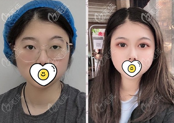 達芬奇雙眼皮術前術后對比圖片 達芬奇雙眼皮術前術后對比圖片