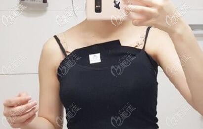 我奧美定豐胸18年取出后的樣子