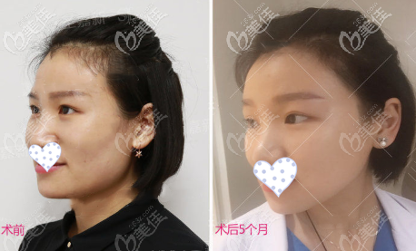 超長(zhǎng)曲線下頜角截骨案例側(cè)臉效果