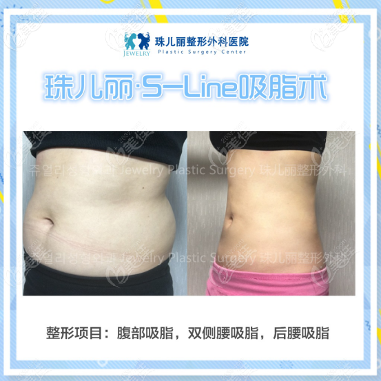 韓國(guó)珠兒麗吸脂案例 韓國(guó)珠兒麗吸脂案例