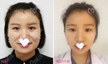 下頜角超長(zhǎng)曲線截骨正面效果圖