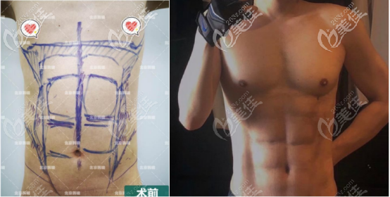 國(guó)內(nèi)吸脂案例 國(guó)內(nèi)吸脂案例