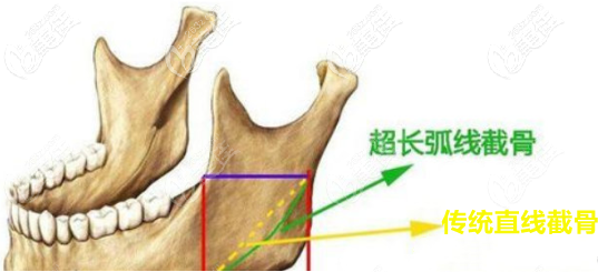 超長(zhǎng)曲線截骨示意圖