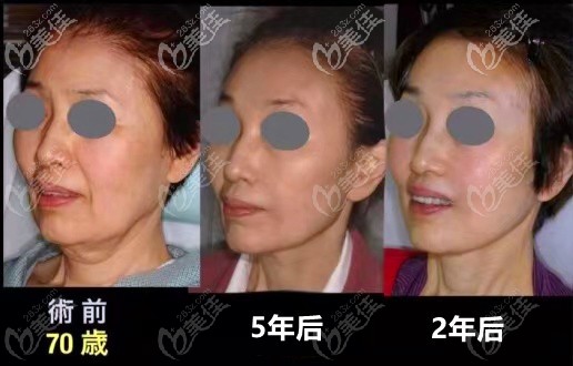 韓國(guó)拉本LABOM整形臉部大拉皮5年后效果圖 韓國(guó)拉本LABOM整形臉部大拉皮5年后效果圖