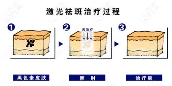 激光祛斑治療過程 激光祛斑治療過程