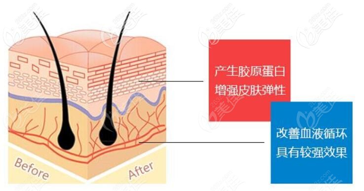 埋線提升原理圖 埋線提升原理圖