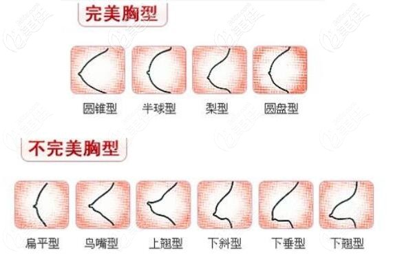 哪些胸型需要做隆胸手術(shù) 哪些胸型需要做隆胸手術(shù)