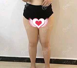 大腿吸脂術(shù)前照 大腿吸脂術(shù)前照