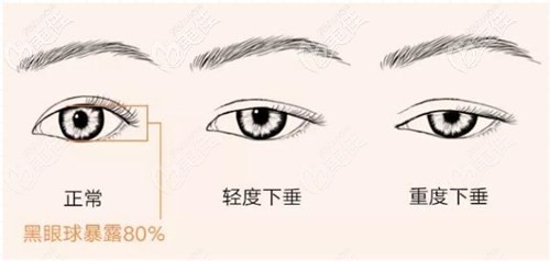 上瞼下垂矯正 上瞼下垂矯正
