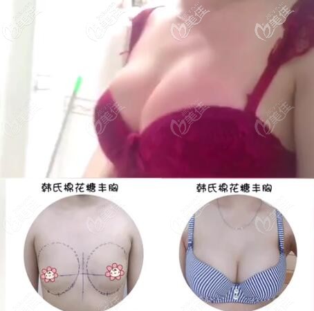 韓嘯棉花糖豐胸真實(shí)案例效果對比圖