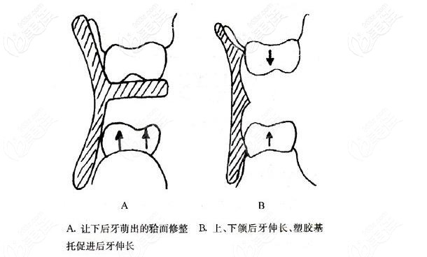 肌激動(dòng)器的矯正原理