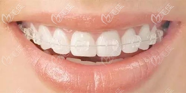 陶瓷半隱形矯正器