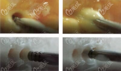 維密脂雕的過(guò)程原理