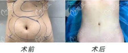 維密脂雕瘦腰腹真人前后對(duì)比照