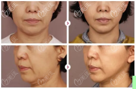 新疆黎美臉部熱瑪吉效果圖 新疆黎美臉部熱瑪吉效果圖