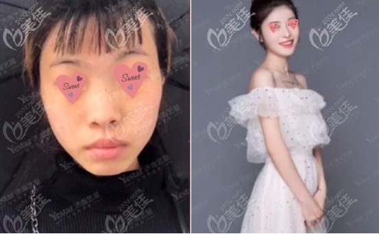 四號求美者的案例圖片以及真實(shí)評價 四號求美者的案例圖片以及真實(shí)評價