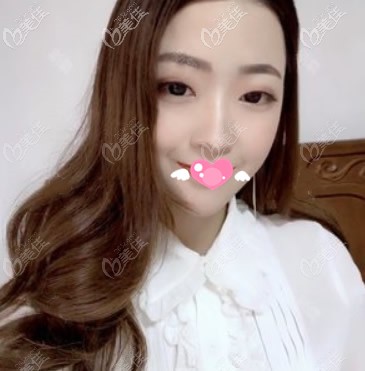 <!--<i data=20240703-sp></i>-->整形醫(yī)院全臉脂肪田填充第7天圖片