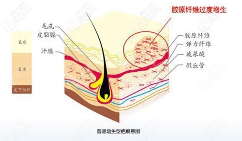 疤痕增生形成的原因 疤痕增生形成的原因