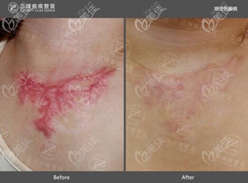 武漢正璞祛燙傷疤痕治療案例 武漢正璞祛燙傷疤痕治療案例