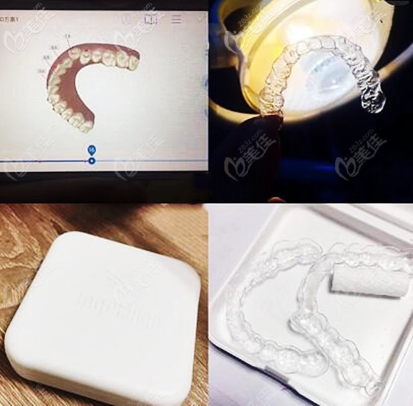 時(shí)代天使雙膜隱形牙套