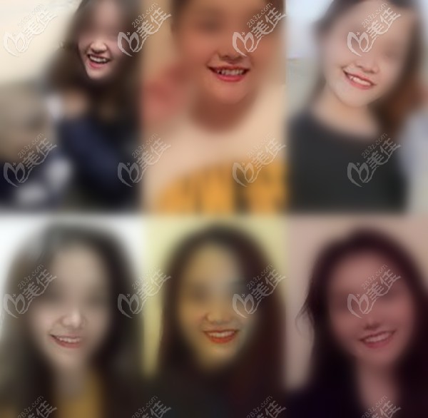 地包天隱形矯正前后