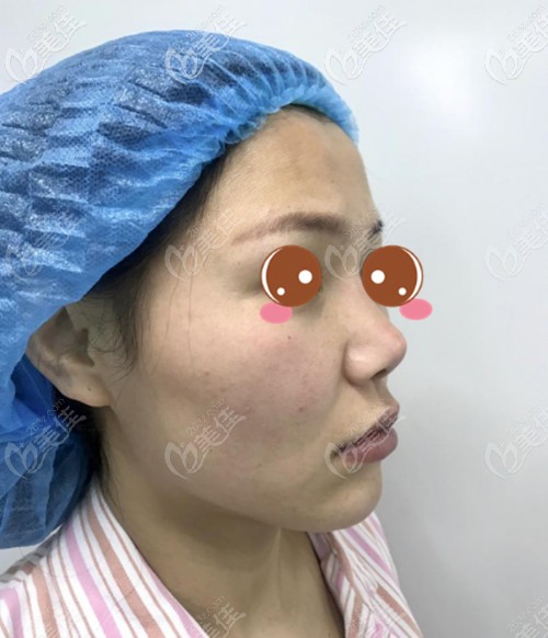耳軟骨隆鼻修復前 耳軟骨隆鼻修復前