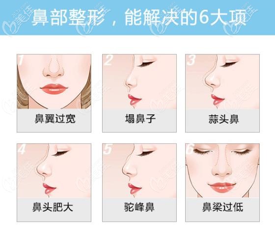 太原時光隆鼻手術能改善哪些鼻部問題？