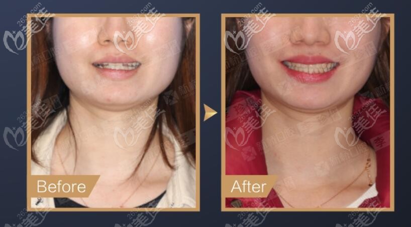 前牙反頜沒有咬合能力使用3M進(jìn)口極速自鎖矯正案例分析