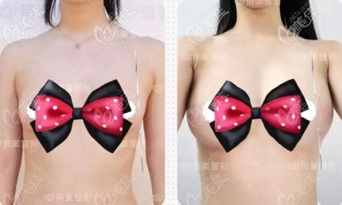 自體脂肪豐胸術(shù)后5年的對比照片