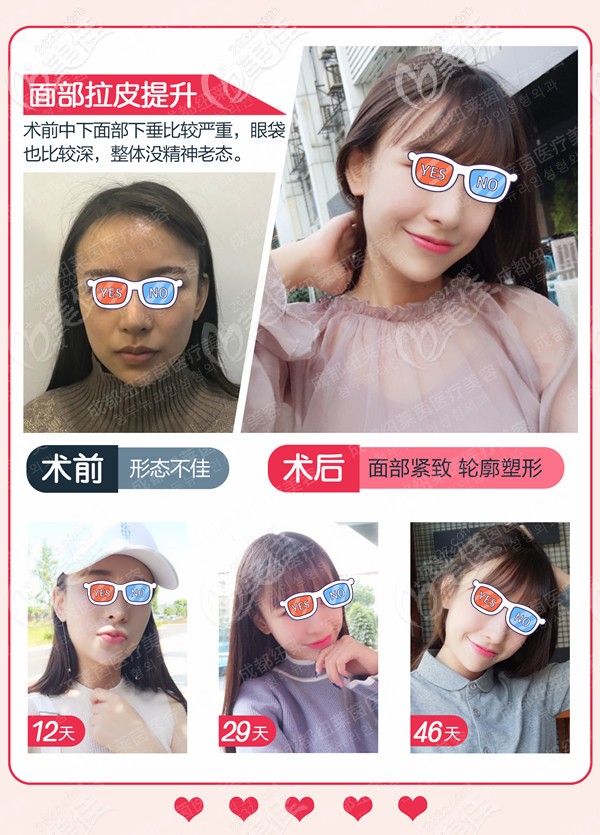 <!--<i data=20240703-sp></i>-->小切口拉皮提升手術(shù)對(duì)比照片 <!--<i data=20240703-sp></i>-->小切口拉皮提升手術(shù)對(duì)比照片