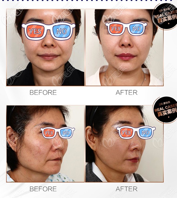 <!--<i data=20240703-sp></i>-->李志浩面部拉皮手術(shù)對(duì)比照片 <!--<i data=20240703-sp></i>-->李志浩面部拉皮手術(shù)對(duì)比照片