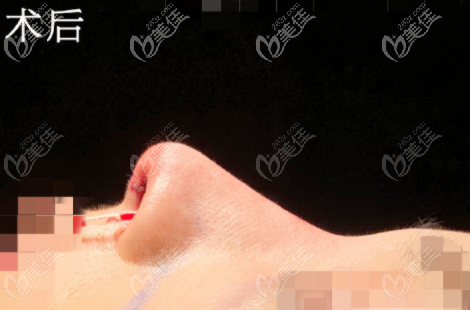 深圳整容醫(yī)生?？溯x鼻子做的尤其好,是眼鼻整形錦旗專業(yè)戶哦