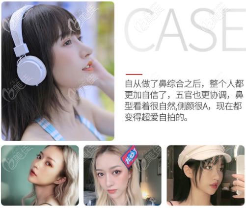 深圳藝星yestar?？溯x醫(yī)生做鼻子怎么樣