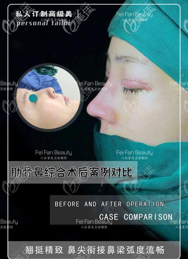 玻尿酸隆鼻效果不好,到六安菲凡做肋骨鼻綜合后鼻尖變尖翹,附對比圖片