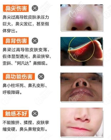 六安菲凡隆鼻手術杜絕鼻尖壓力、鼻背皮膚變薄等情況