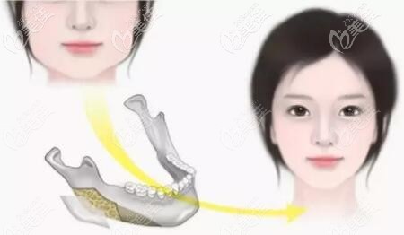下頜角整形術(shù)全過(guò)程是怎么做的